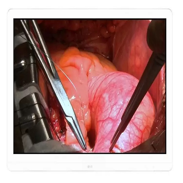 màn hình hiển thị phẫu thuật của LG cho Y tế